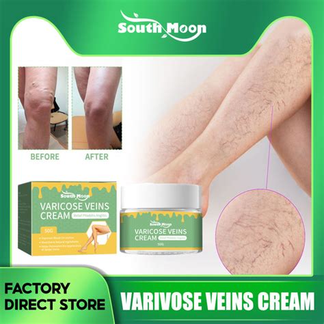 South Moon Varivose Veins Cream Varicose Veins Treatment Cream