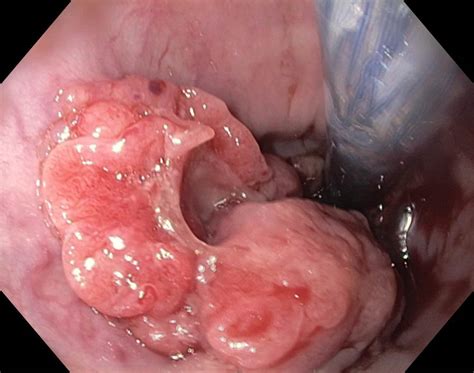 Esophagus Cancer