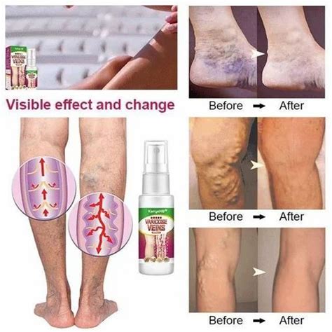 Vein Healing Varicose Veins Treatment Spray Ml In Nagpur Omnimart