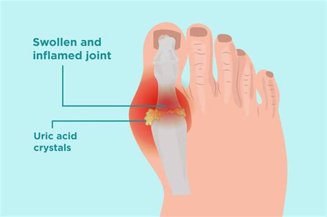 How To Lower Uric Acid Levels In The Body