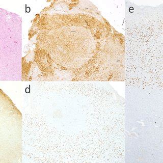 Morphological And Immunohistochemical Features Of The Case Described In