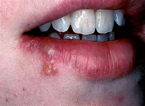 Imagens De Herpes Labial Retoedu