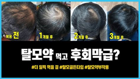 탈모 약 후기 탈모약 먹고 후회막급 탈모극복 후기 프로페시아 복용 3개월 더 일찍 먹을 걸 M자탈모 정수리탈모