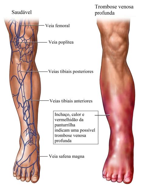 Trombose Venosa Profunda Ou Tvp Sintomas Tratamento E Fisioterapia