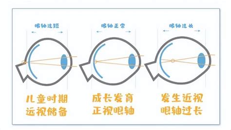 「遠視儲備」是什麼？遠視越多越好嗎？ 每日頭條