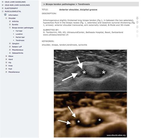 Efsumb Shoulder Biceps Tendinosis Musculoskeletal Ultrasound Flickr