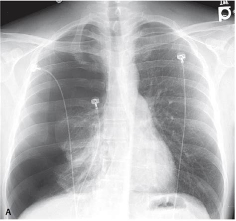 Patient With Pleuritic Chest Pain And Shortness Of Breath Manual Of