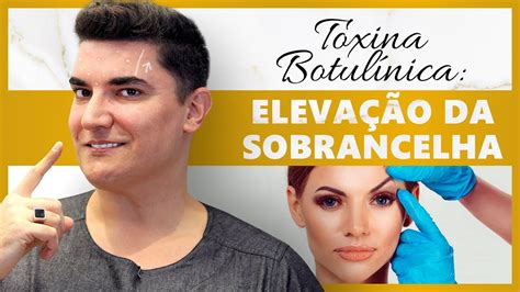 Botox® Toxina Botulínica Elevação Da Sobrancelha Botox Youtube