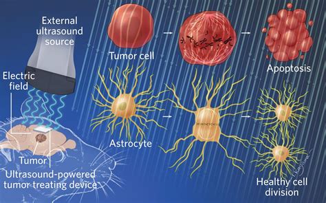 Implantable Device Zaps Cancer Cells Using Electric Fields TS Digest