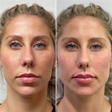 Facefix Sculptra Beautyfix Medspa 212 366 4787