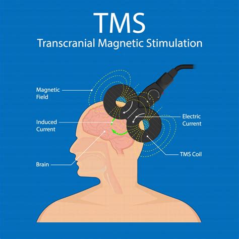 Repetitive Transcranial Magnetic Stimulation Rtms Ncmd