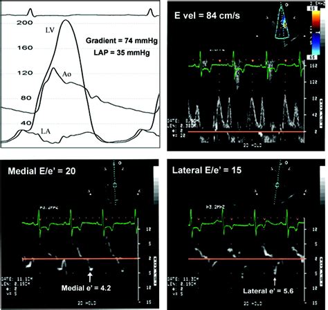 Evaluation Of Left Ventricular Filling Pressures By Doppler