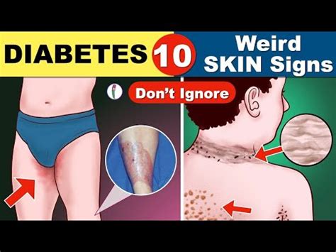 Diabetes Alerts Warnings Signs That Can Appear On Your Skin Your