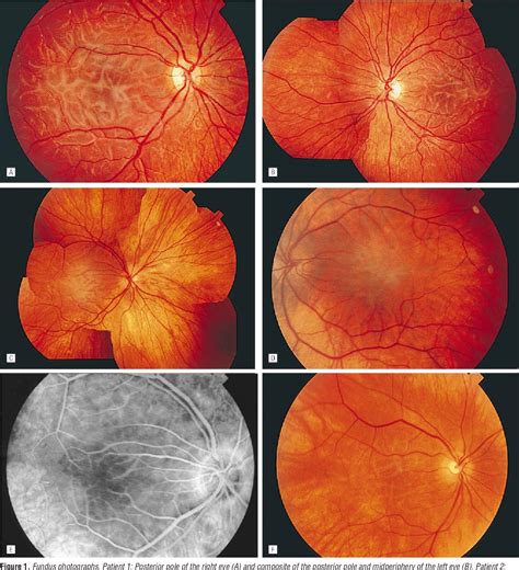 Figure From Cone Rod Dystrophy With Serpentine Like Retinal Deposits