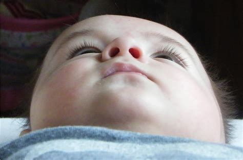 Plagiocephaly Treatment in the UK