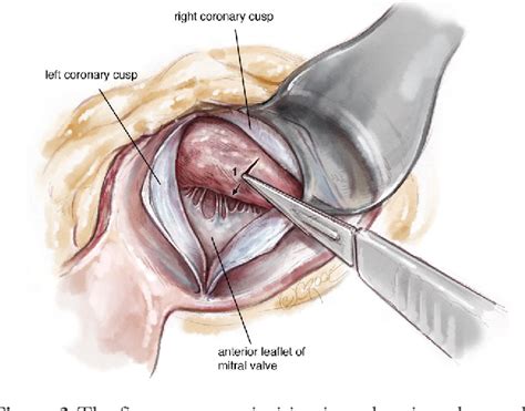 Figure 3 from Transaortic septal myectomy: techniques and pitfalls ...