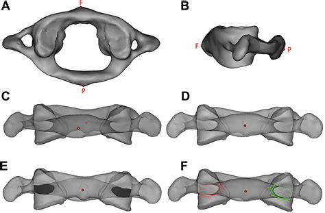 Feasibility Of Atlas Pedicle Screw Fixation Perpendicular To The