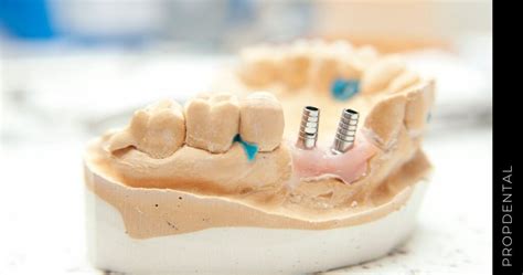Transposición Del Nervio Dentario Inferior