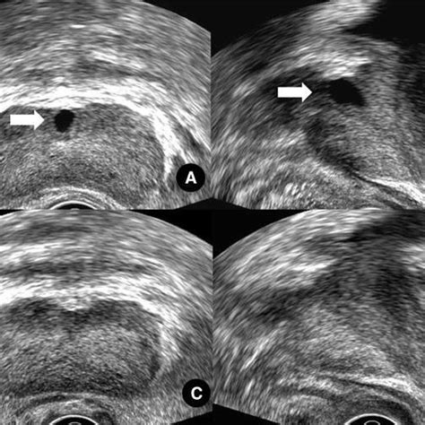 Endoscopic View Of Verumontanum A Prostatic Utricle Orifice And