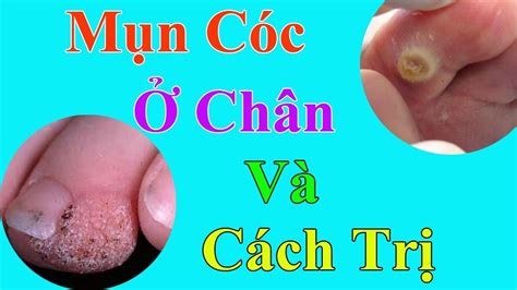 Bạn Cần Biết Mụn Cóc Ở Chân Và Cách Điều Trị YouTube