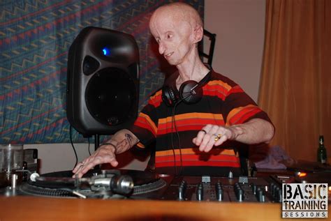 10 Oldest People With Progeria