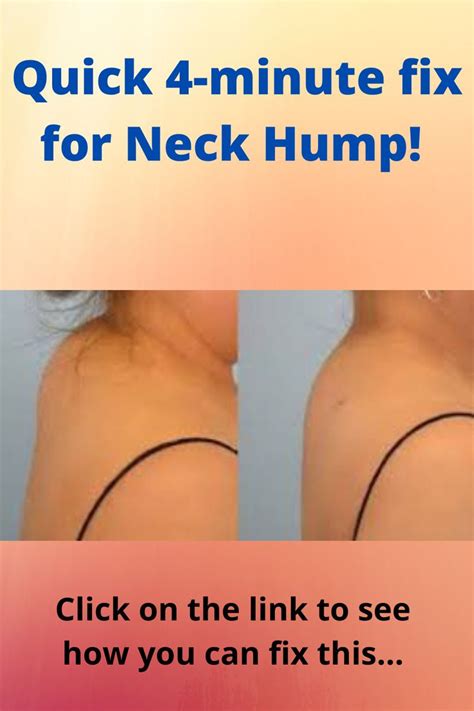 Quick 4 Minute Fix For Neck Hump Neck Hump Neck Exercises Senior