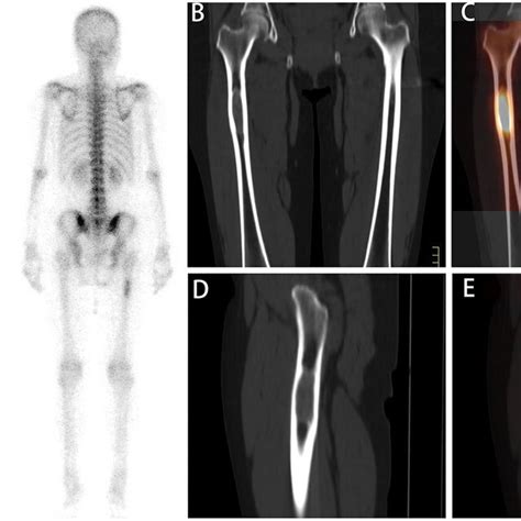 A Whole Body Scan A Revealed A Focal Area Of High 99mtc Mdp Activity