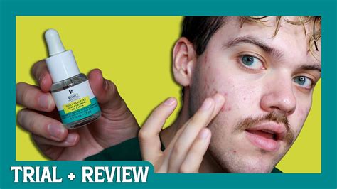 Kiehls Truly Targeted Acne Clearing Pimple Patch Trial Review