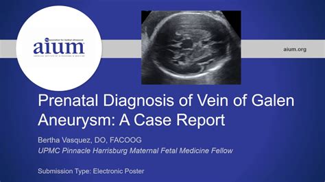 Prenatal Diagnosis Of Vein Of Galen Aneurysm A Case Report Youtube