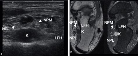 [ultrasound Of The Tarsal Tunnel Normal And Pathological Imaging Features] Semantic Scholar