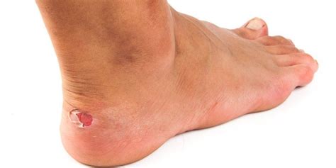 Top Tips To Prevent And Treat Blisters Moreland Podiatry