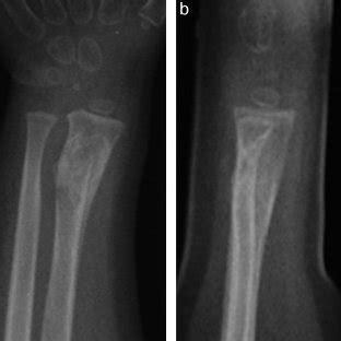 Radiografias nas incidências anteroposterior a e perfil b após