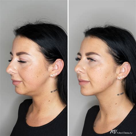 Jawline Behandlung mit Hyaluronsäure bei M1 Med Beauty