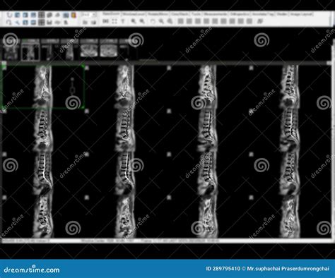 MRI L-S Spine or Lumbar Spine Sagittal View for Diagnosis Spinal Cord ...