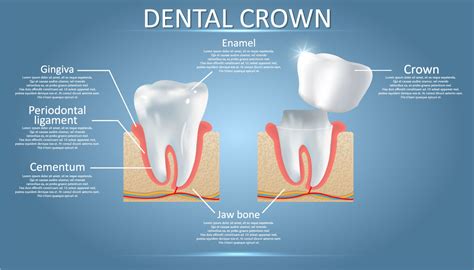 5 Benefits Of A Dental Crown