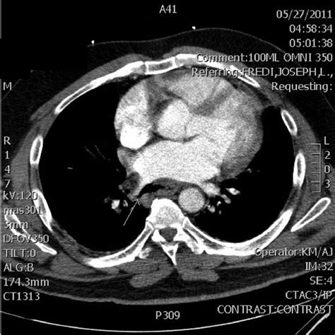 Computed Tomography Angiogram Of Chest The White Arrow Shows Location