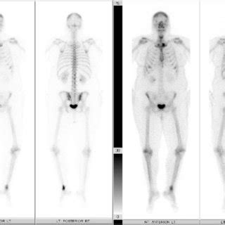 E Technetium M Hydroxymethylene Diphosphonate Tc M Hdp Whole Body