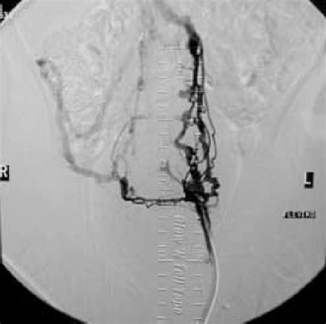 Deviations Of Placement Function Of Permanent Central Vein Catheters