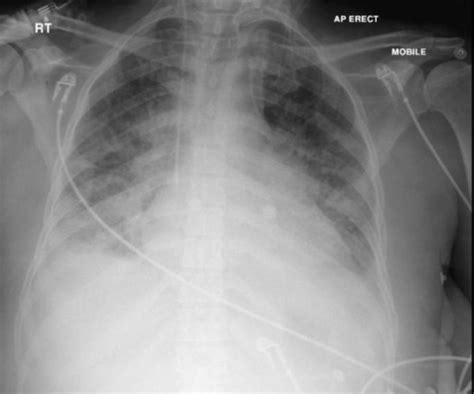 Chest X Ray Showing Bilateral Diffuse Infiltrates Open I