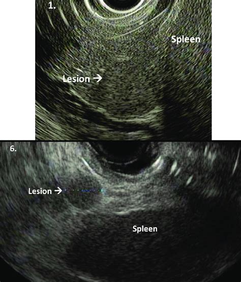 Images Of Intrapancreatic Accessory Spleen Study Images 1 And 6