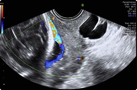 37 Diagnosis And Management Of Vasa Previa American Journal Of Obstetrics And Gynecology