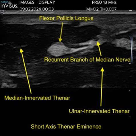 Considerations For Choosing Neuromuscular Ultrasound Technology Natus