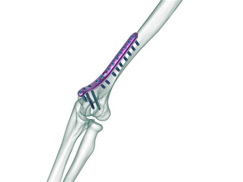 True Lock Distal Humerus Medial Plate Truemed Medikal