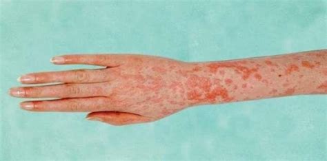 Scarlatiniform rash of scarlet fever. 16 | Download Scientific Diagram