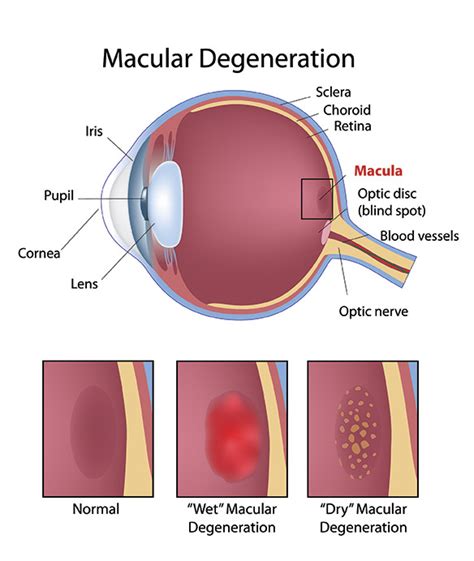 Macular Degeneration Pgheyemeds