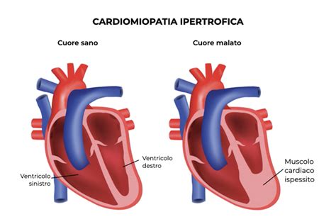 Cardiomiopatia Ipertrofica Cos Diagnosi E Cura Ihealthyou