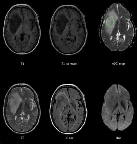 Case From The Training Dataset Showing Type Ii Glioma T2 Flair