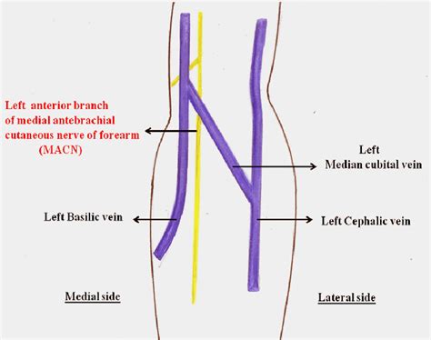 Cubital Fossa Syndrome