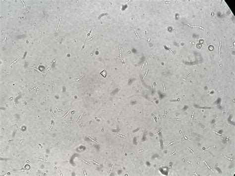 Urine Sediment of the Month: Bacterial Variant Forms - Renal Fellow Network