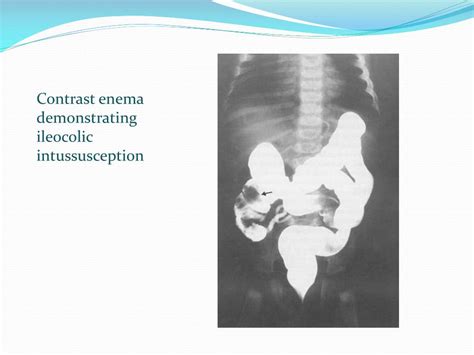 Ppt Intussusception Powerpoint Presentation Free Download Id1902034